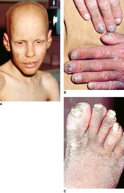 Ectodermal Dysplasias | Obgyn Key