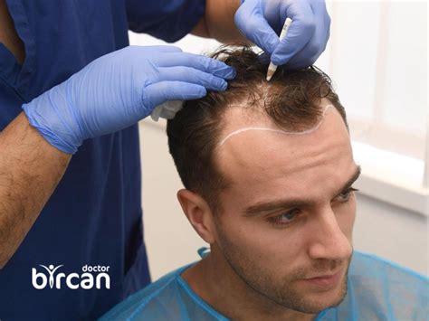 What is the Success Rate in Hair Transplantation?