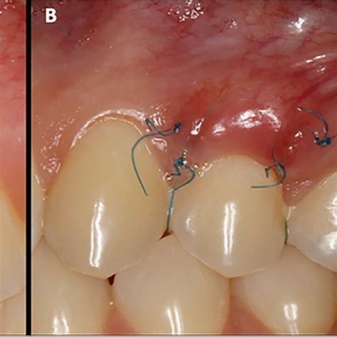 The surgical procedure in the thick connective tissue graft group. A ...