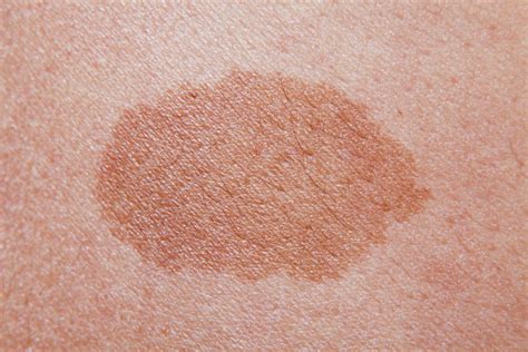 New moles and what to look out for - Medical News Corner