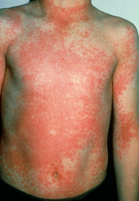 Scarlet fever rash – Bild kaufen – 11843063 Science Photo Library