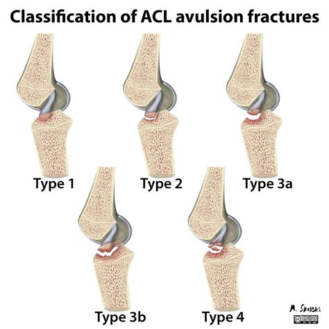 Recuperación y tratamiento de la fractura de las espinas de la rodilla ...