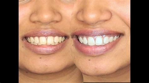 Diy Turmeric Teeth Whitening Paste : 4 Natural Diy Teeth Whitening Recipes Simple Pure Beauty ...