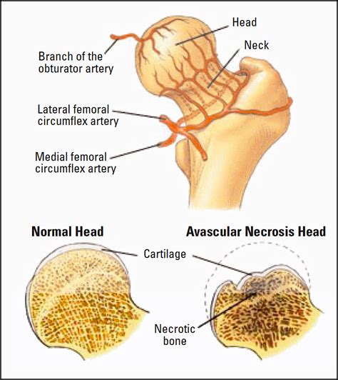 How to Treat Avascular Necrosis Hip Pain in India?