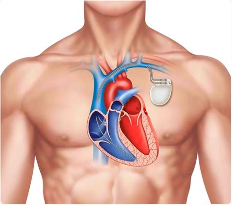 What is a Pacemaker?