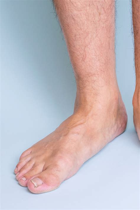 What is overpronation? Causes and treatments for your feet. – Bilt Labs