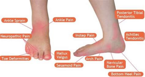 [DIAGRAM] Diagram Foot Pain By Location - MYDIAGRAM.ONLINE