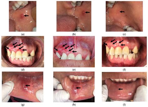 Biomedicines | Free Full-Text | Healing of Recurrent Aphthous Stomatitis by Non-Thermal Plasma ...