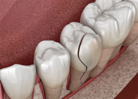 Astoria Dentist Looks At What To Do If You Chip A Tooth | Astoria, NY