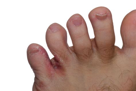 Pictures Of Fungal Infection On Foot Online | emergencydentistry.com