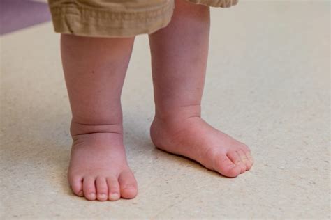 What Is Benign Congenital Hypotonia? | Surestep