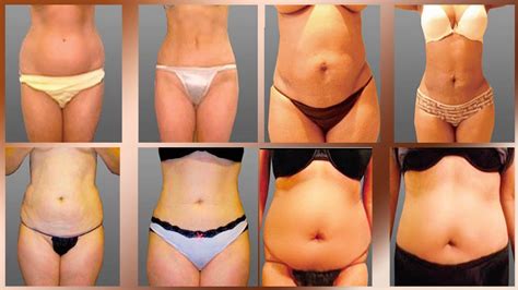 Liposuction Cosmetic Surgery Before and After in Mexicali Mexico - YouTube