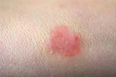 Ringworm: Types, Symptoms, Causes, Diagnosis, Treatment and More