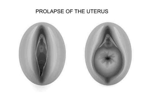 Sign and Symptoms of Prolapse Uterus - PT Master Guide