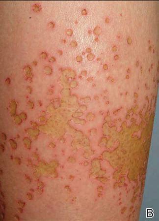 Sulfur Spring Dermatitis | MDedge Dermatology