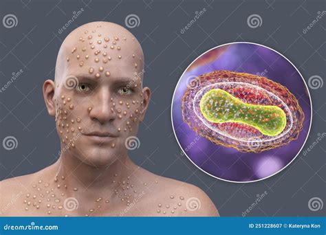 A Man with Smallpox Disease and Close-up View of Variola Virus, a Virus ...