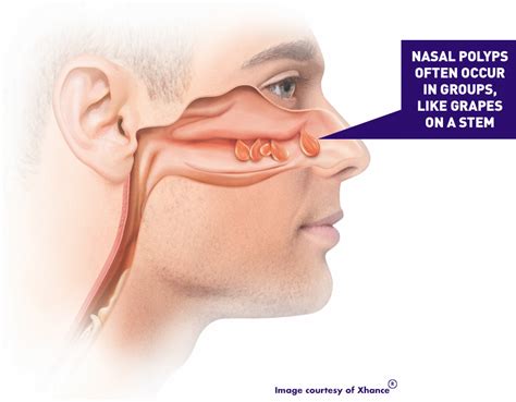 Nasal Polyps Removal Surgery