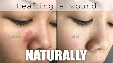 Healing a face wound naturally - YouTube