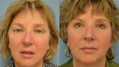 Eyelid Surgery Before & After Photos Patient 143 | San Francisco, CA ...