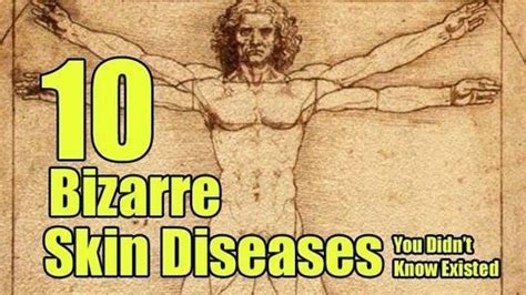 10 Bizarre Skin Diseases You Didn’t Know Existed (Warning Graphic Photos) | MY B*S* IS BOSS ...