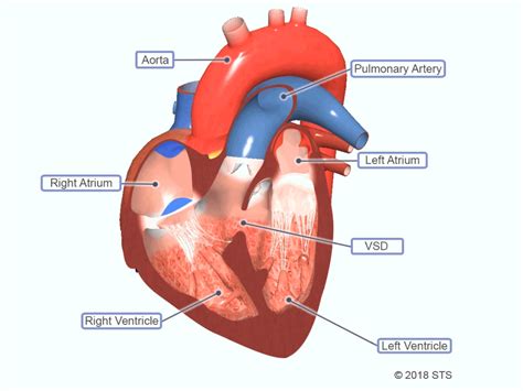 Ventricular septal defects (VSDs) are one of the most common congenital heart defects. A ...