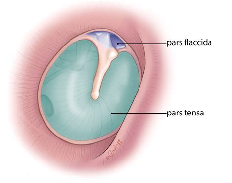 Tympanic Membrane Perforation Repair