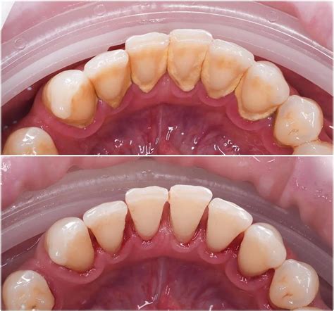 Limpieza dental: antes y después, ¿cuánto dura? – DENTALINE