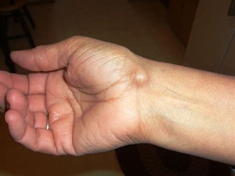 Ganglion Cyst | Wikipedia: The exact cause of the formation … | Flickr