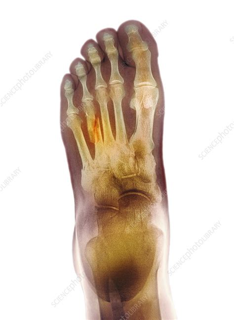 Fractured foot, X-ray - Stock Image - C006/8400 - Science Photo Library