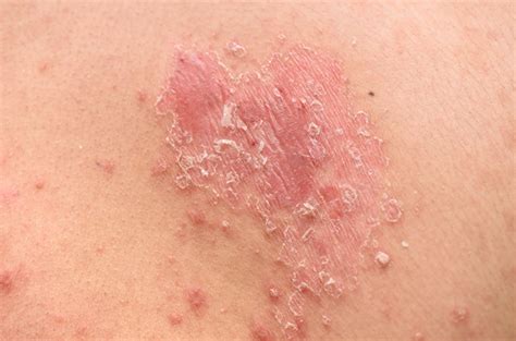 Peduli Kesehatan Kulit, Ini Bedanya Pityriasis Rosea dan Eksim