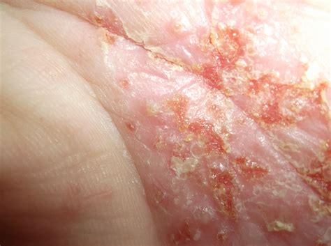 palmoplantar psoriasis - pictures, photos