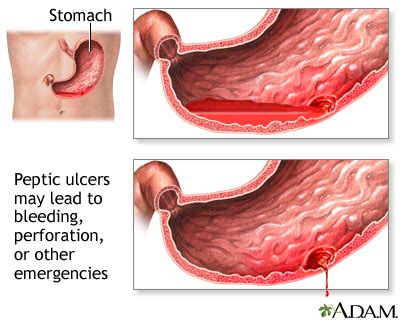 Duodenal Ulcer