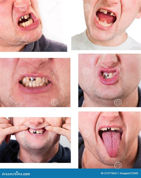 Broken Tooth Removal With Dental Caries On White Stock Photo