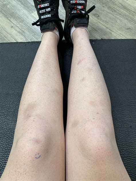 anyone else get bruises like this? What’s the cause? If anyone knows