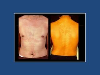 tinea versikolor  panu peyakit general pptx