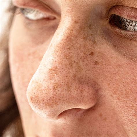 sun damage treatment skin healing zia cosmetic clinic