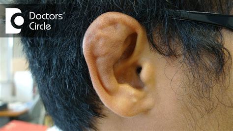 What causes Cauliflower Ear? - Dr. Gayatri S Pandit - YouTube