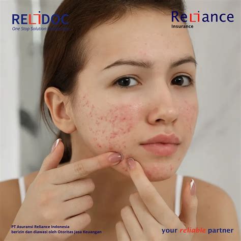 perawatan wajah berjerawat relidoc asuransi reliance