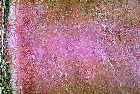 Coccidioidomycosis - Wikipedia