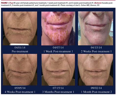 Laser Erbium Antes E Depois - Erbium Laser