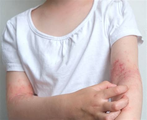 Childhood Psoriasis | Psoriasis Treatment | FMS Skin & Hair Clinics