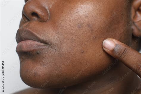 Brown skin with dark spots, hyperpigmentation on brown skin, african ...