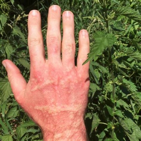 Stinging Nettle Rash: Pictures, Treatment, Remedies