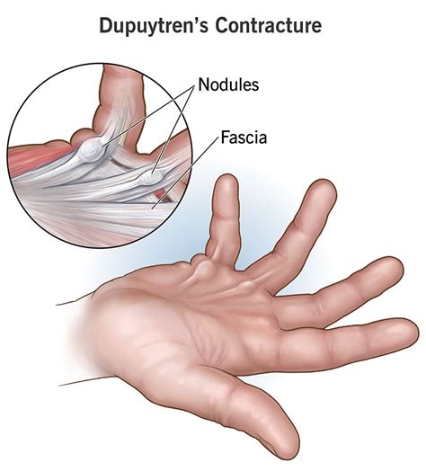 Dupuytren's Contracture: Causes, Symptoms, Treatment and Prognosis