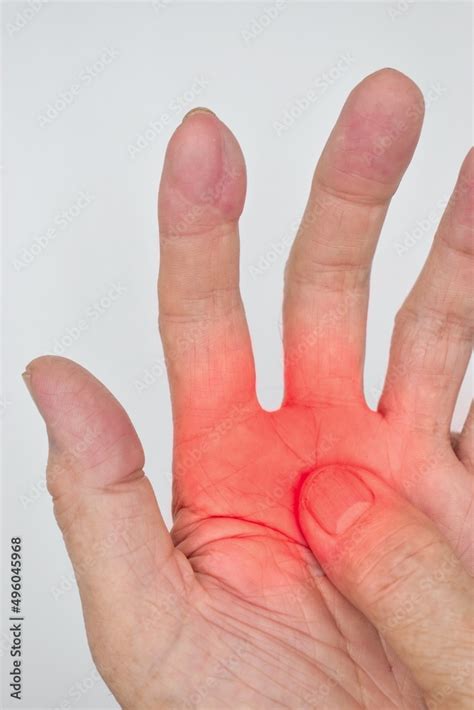 Painful palm of Asian man. Concept of compartment syndrome, cellulitis ...