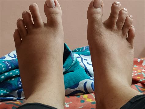 Recurring swollen foot : r/medical_advice