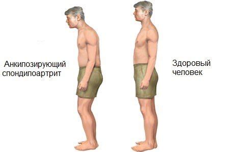 Скільки може прожити людина з хворобою Бехтерева