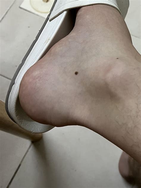 What causes feet to look like this seconds after sitting down? : r