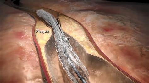 Cardiac Catheterization, Stent into Body Stock Illustration ...