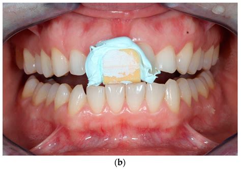 Occlusal devices fabricated using fully digital workflow have better